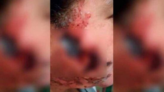 Arroja ácido al rostro de su ex novia por terminarlo