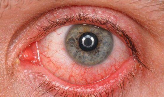 Casos de conjuntivitis aumentan durante el invierno