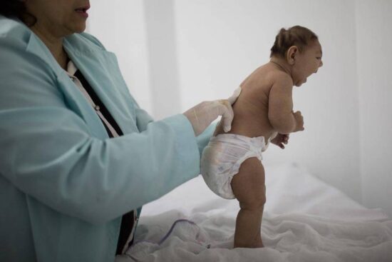 Confirman primer caso de microcefalia por zika en México