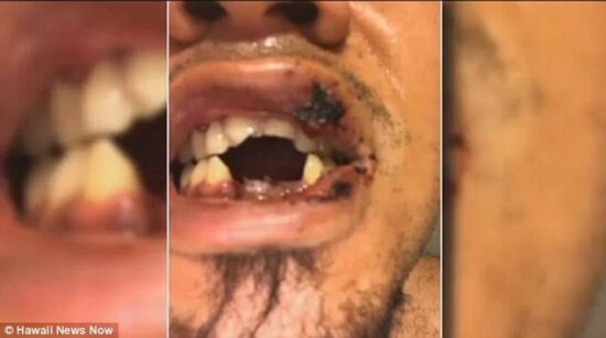 Le explota cigarrillo electrónico y pierde dientes