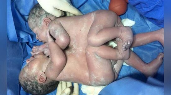 IMSS separa con éxito a siameses en Guanajuato