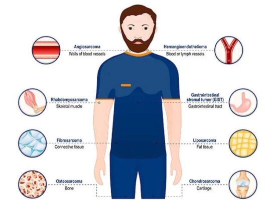 Sarcoma: pocos casos, pero todos alarmantes